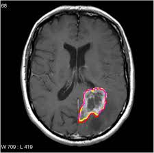 Brain Tumor Detection Using MRI Segmentation
